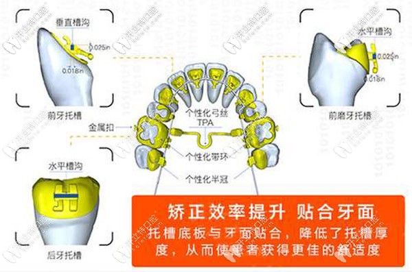 舌侧全隐形矫正的特点 舌侧全隐形矫正的特点
