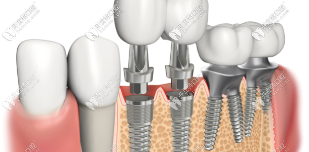 德国种植牙构造
