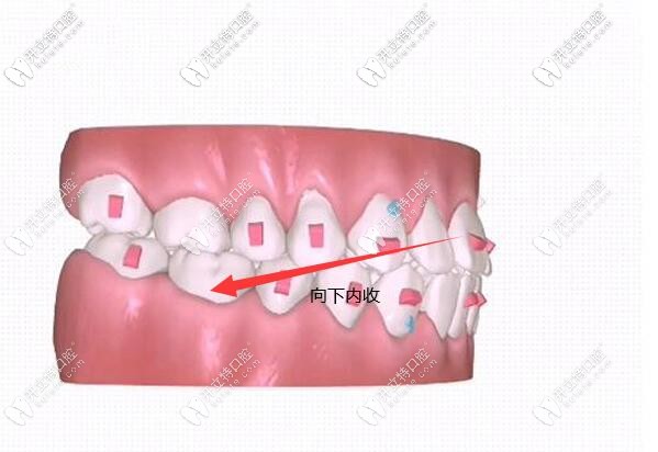 前牙压低向下内收
