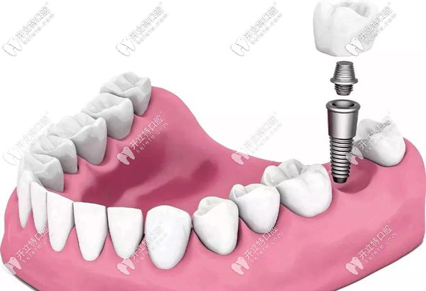 半口即刻种植牙的技术