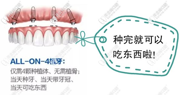 石家庄allon4全口种植牙