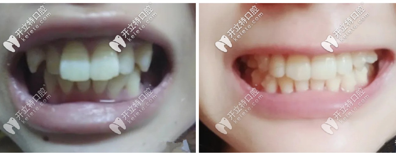 一年半的时间,牙套已经变得<span style= 一年半的时间,牙套已经变得<span style=