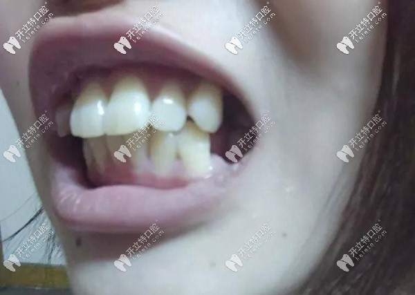 牙齿的侧面照,外凸的厉害 牙齿的侧面照,外凸的厉害
