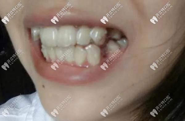 你能看到隐形牙套的附件吗 你能看到隐形牙套的附件吗