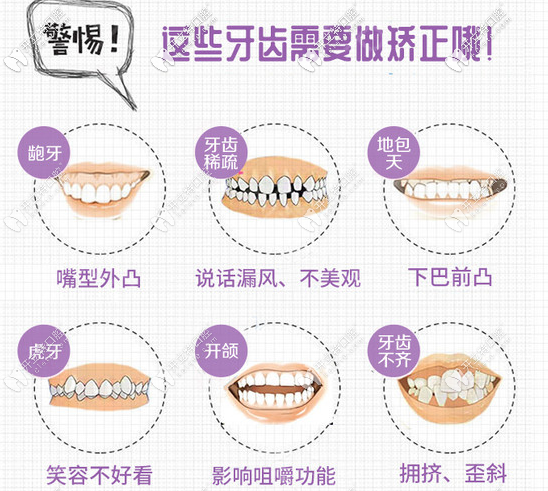 那些牙齿症状需要牙齿矫正