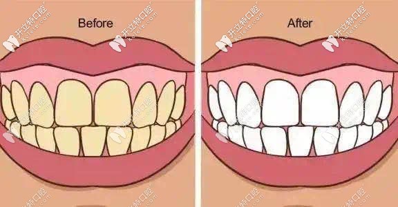 合肥大众口腔修复牙齿前后效果