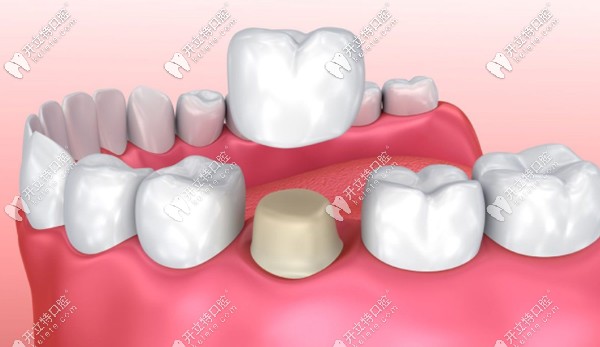 穗华口腔医院的牙齿修复活动价