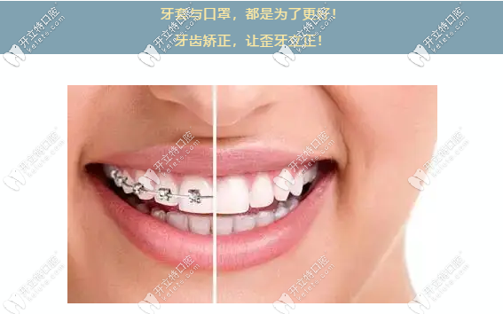 牙齿正畸就选传统金属箍牙套