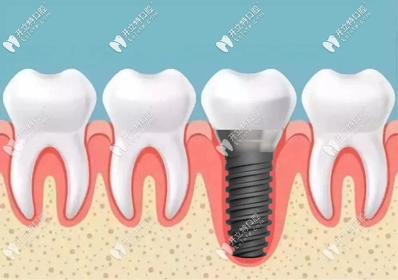 牙周病对种植牙的影响