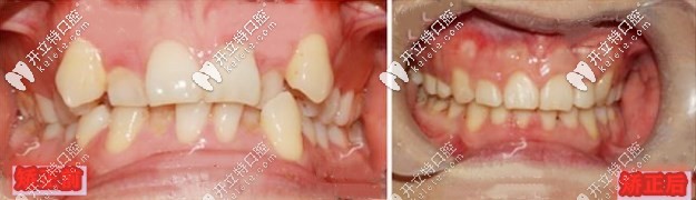 矫正前后对比