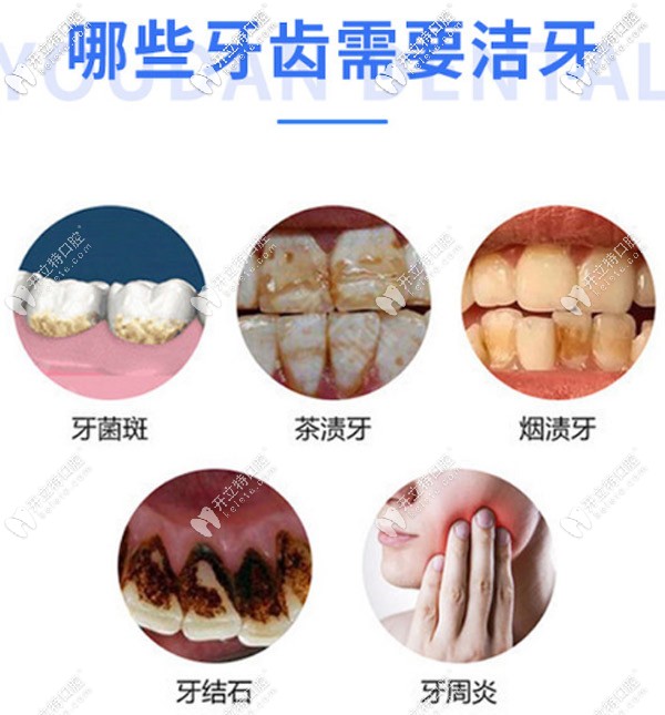 哪些牙齿需要定期洁牙