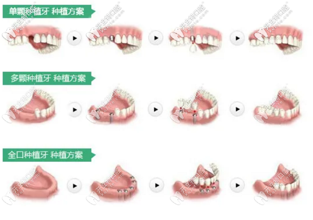 石家庄中诺口腔种植牙团购优惠价格活动正在进行中