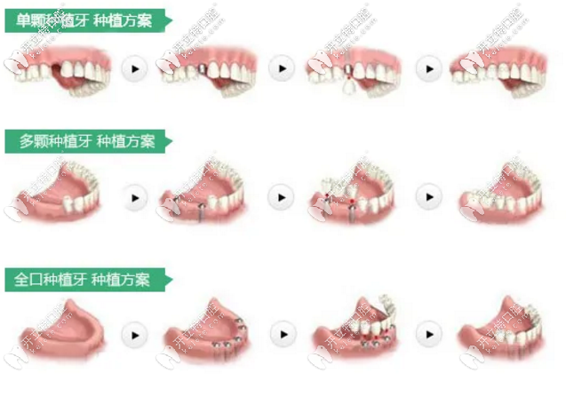 种植牙方案