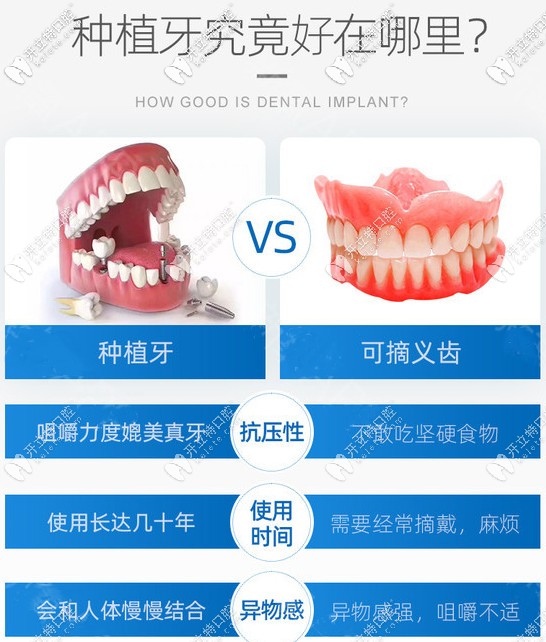 种植牙VS活动假牙