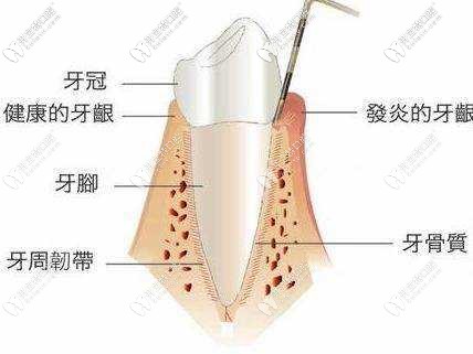 如何确定自己是牙髓炎