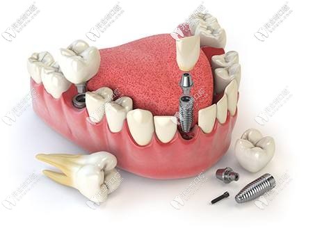 种植牙植入过程图
