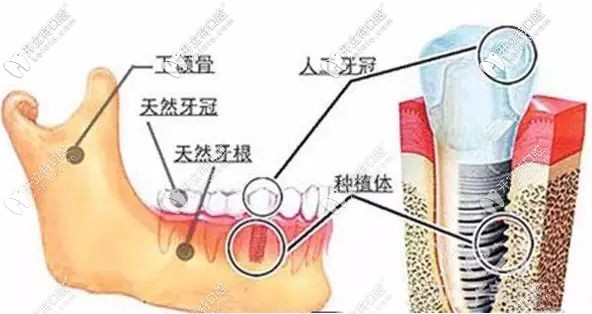 种植牙的解剖图