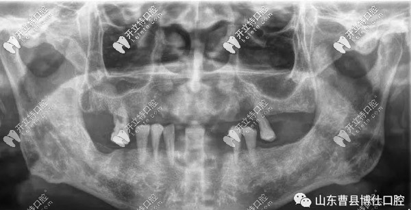 拍CT拍显示牙槽骨萎缩