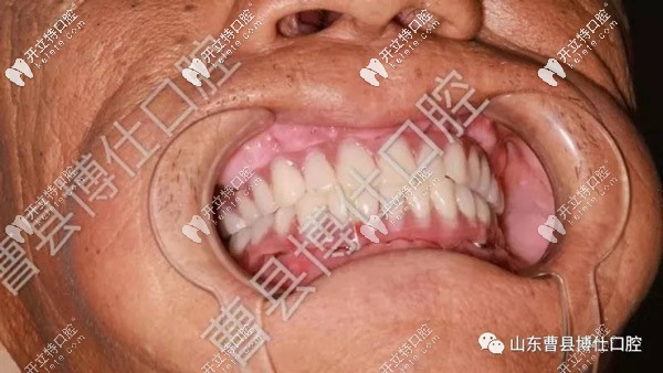 做完种植牙后的牙齿情况