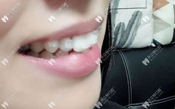 在广州穗华口腔戴陶瓷半隐形牙套的样子