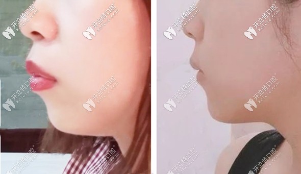 开颌矫正的前后对比图