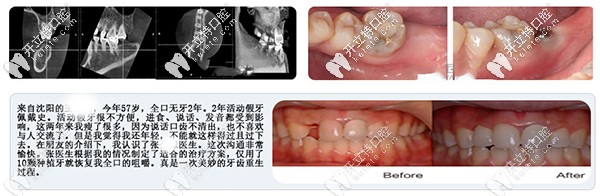 沈阳盛大口腔单颗牙缺失案例