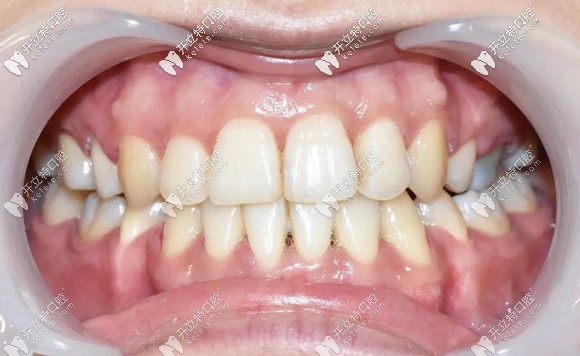 穗华口腔矫正后的牙齿正面效果图