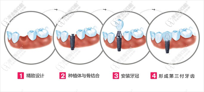 来宾永洁口腔种植牙过程图