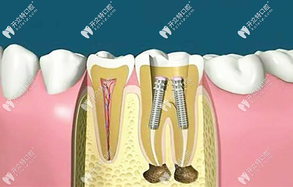牙齿桩核修复的材料不同费用也不同