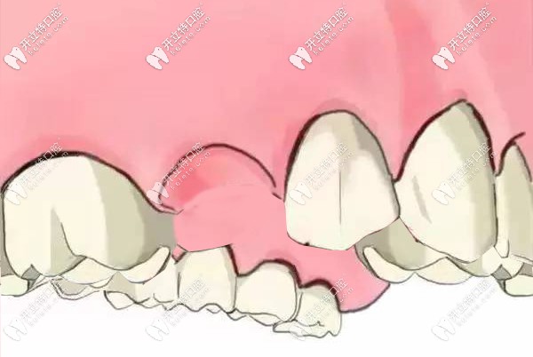 用卡通图展示种植牙前口内样子