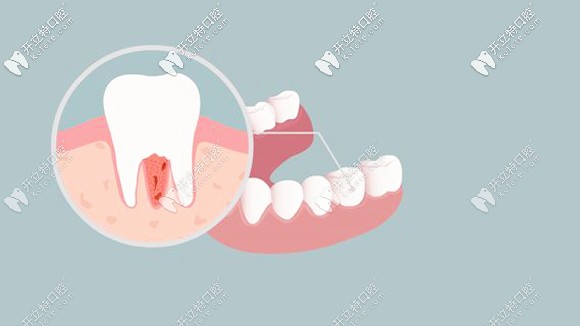 正畸期间治疗和预防蛀牙的方法介绍