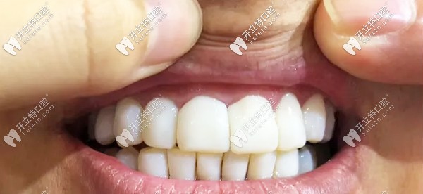 为何做完牙贴面后牙齿像龅牙？