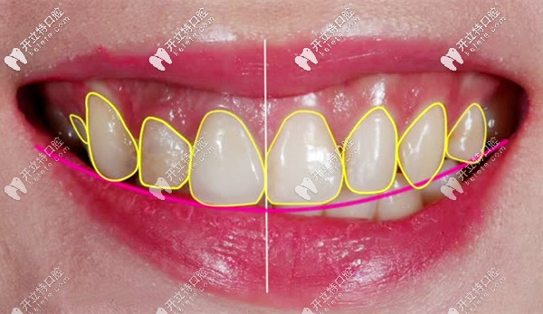 牙齿贴面的方案设计图