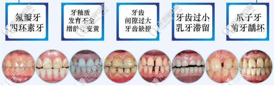 贴面的适用情况