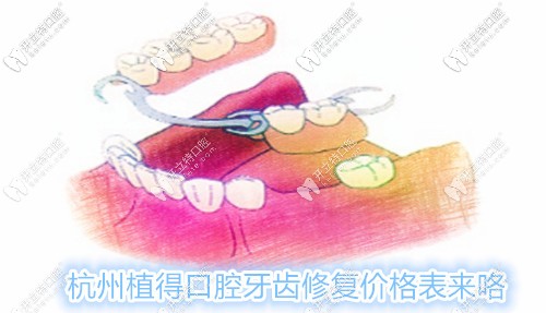 杭州植得口腔修复价格表