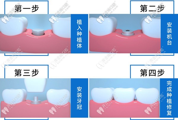 单颗种植牙步骤示意图