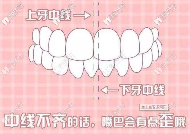 牙性偏颌