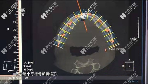 可以看出牙槽骨已经萎缩了 可以看出牙槽骨已经萎缩了