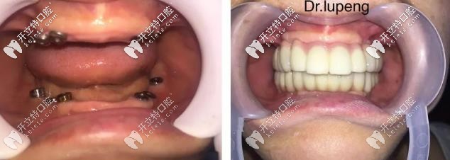 58岁阿姨在众牙口腔做全口种植牙的前后对比