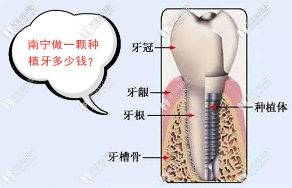 南宁做种植牙的价格是多少钱