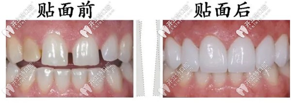 全瓷牙贴面用于前牙美学修复的主要优势体现在哪里？