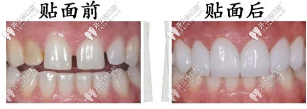 贴面前后效果图