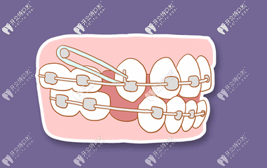牙套皮筋挂法示意图告诉你:牙套橡皮圈怎么挂，戴多久