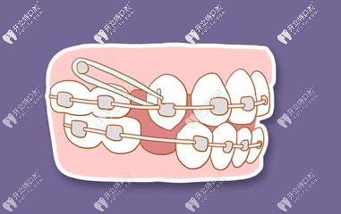 正畸橡皮圈图示