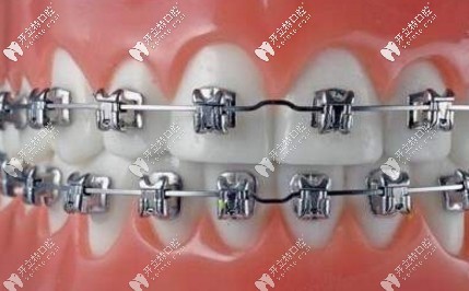传统金属托槽牙套照片