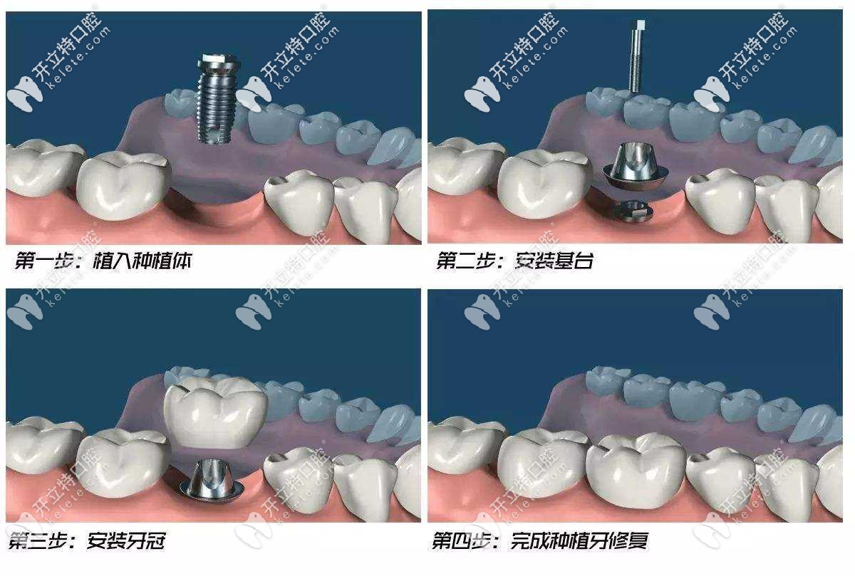 种植牙的简单步骤