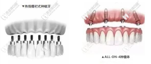 传统点种和all-on-4种植的区别