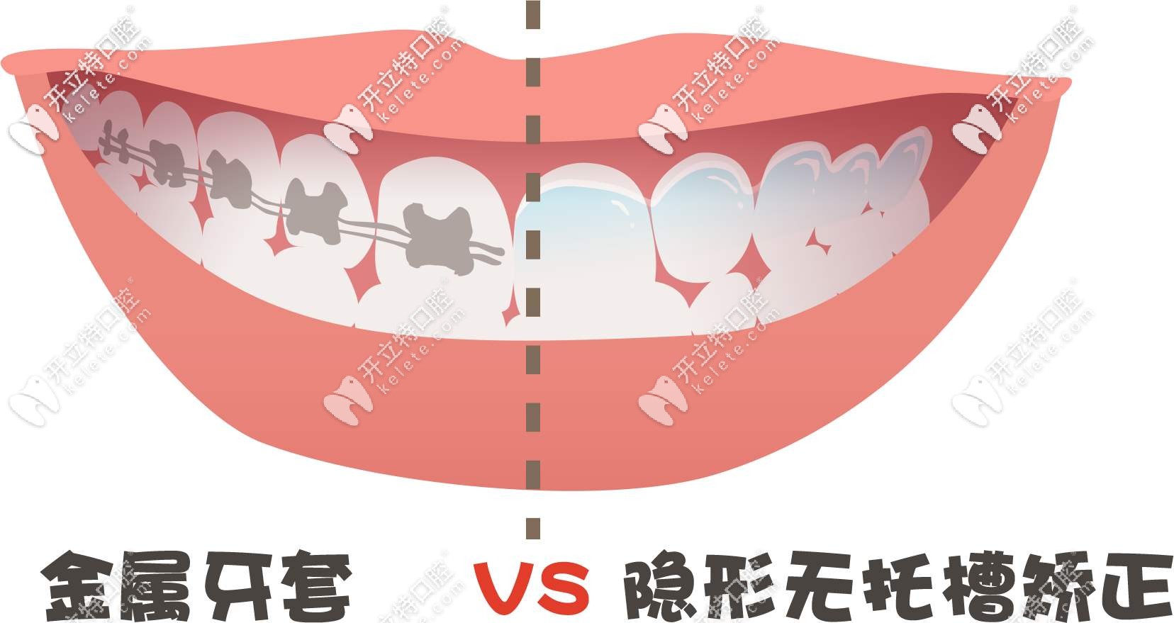 金属牙套和隐形牙套图示 金属牙套和隐形牙套图示