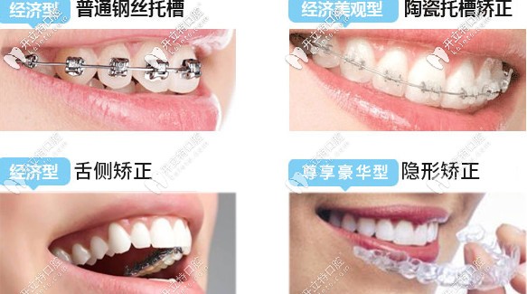 牙齿矫正器的种类 牙齿矫正器的种类