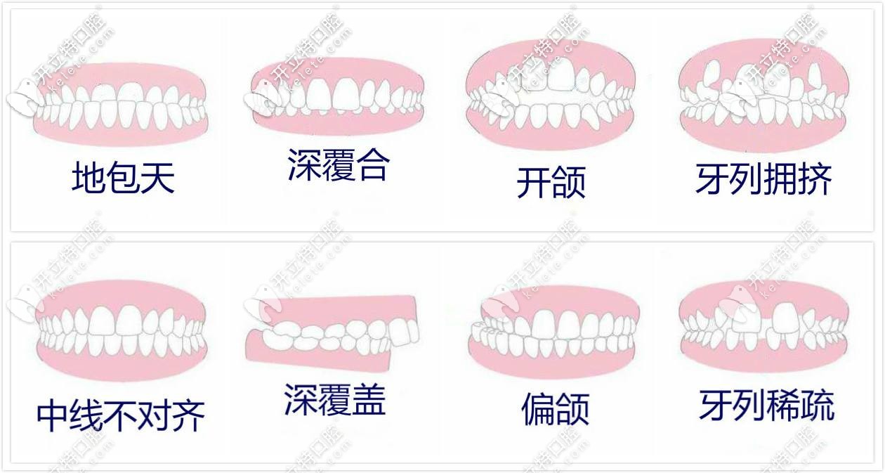 牙齿矫正适应症 牙齿矫正适应症